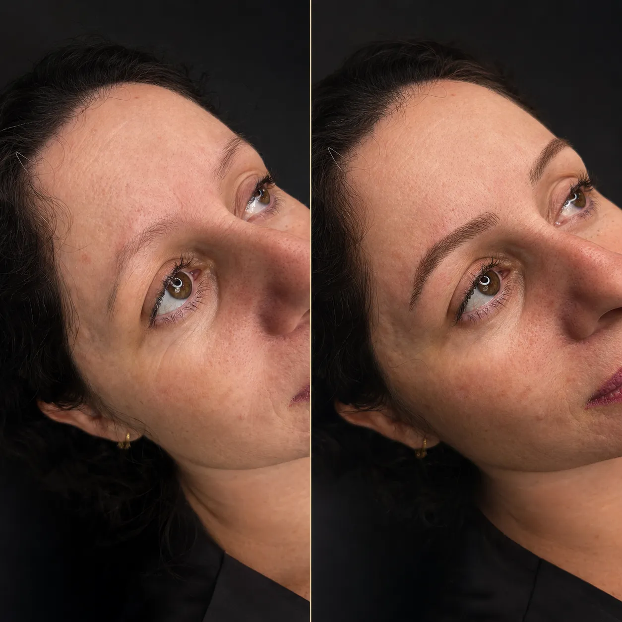 Antes e depois de um procedimento de reabilitação de sobrancelha pela Fabiana Alves